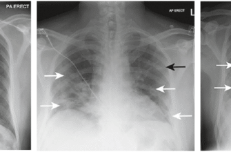Пневмофібротичні зміни в легенях: причини, діагностика, лікування