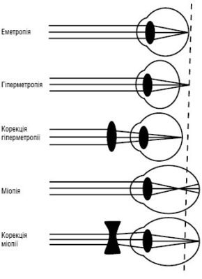 Які лінзи застосовуються для корекції зору при далекозорості: оптимальний вибір