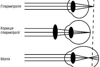 Які лінзи застосовуються для корекції зору при далекозорості: оптимальний вибір