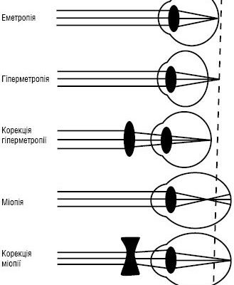 Які лінзи застосовуються для корекції зору при далекозорості: оптимальний вибір