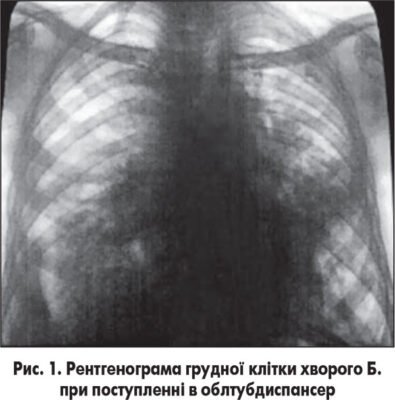 Інфільтративні зміни: що це і як впливають на здоров’я?