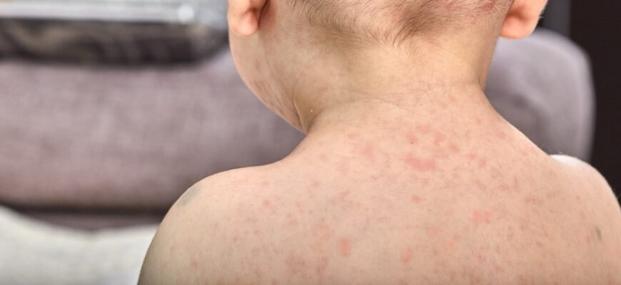 Висока температура у дитини без симптомів: що робити батькам?