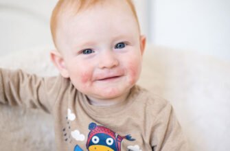 Себорейний дерматит у дитини: причини, симптоми та лікування