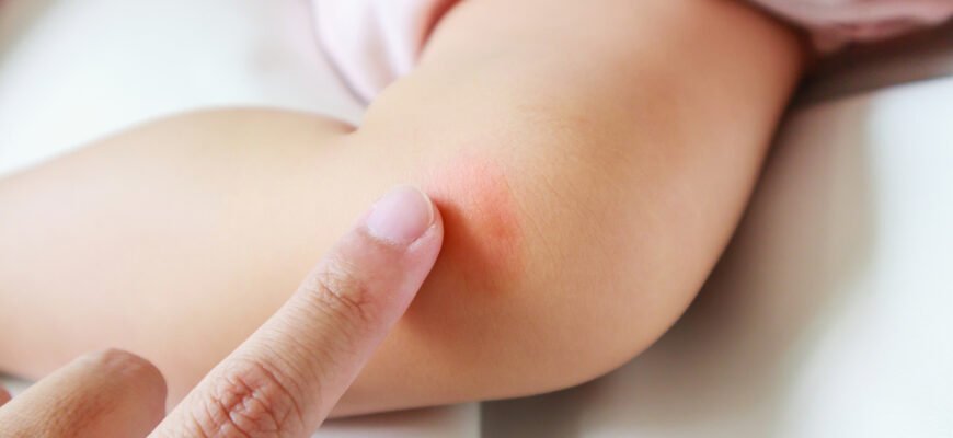 Як лікувати лишай у дитини: ефективні методи та поради Як лікувати лишай у дитини: ефективні методи та поради