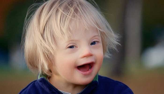 Хвороба Дауна це: причини, симптоми та підтримка сімей