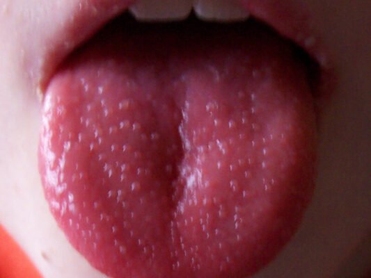 Висип на язиці у дитини: причини, симптоми та лікування