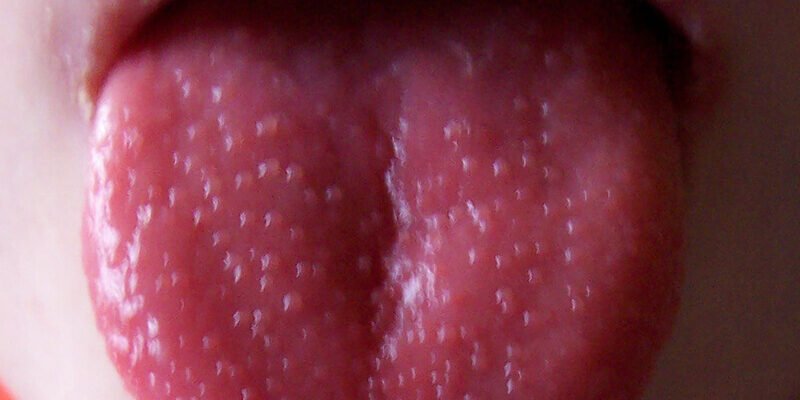 Висип на язиці у дитини: причини, симптоми та лікування