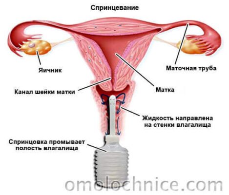 Як правильно спринцюватися при молочниці: поради та рекомендації