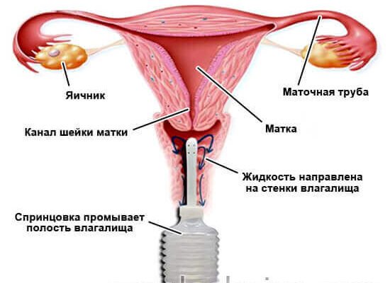 Як правильно спринцюватися при молочниці: поради та рекомендації