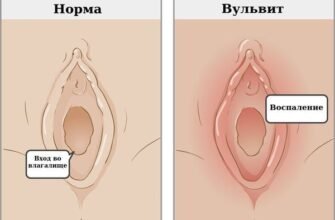 Як виглядає вульвіт у дитини: ознаки та симптоми