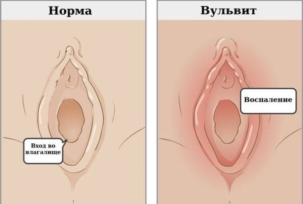 Як виглядає вульвіт у дитини: ознаки та симптоми