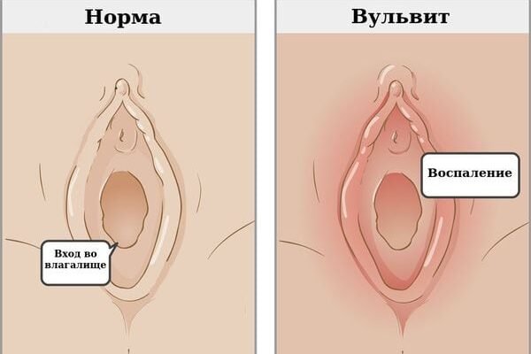 Як виглядає вульвіт у дитини: ознаки та симптоми Як виглядає вульвіт у дитини: ознаки та симптоми