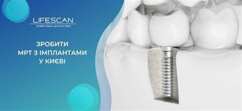 Чи можна робити МРТ з коронками: важлива інформація для пацієнтів Чи можна робити МРТ з коронками: важлива інформація для пацієнтів