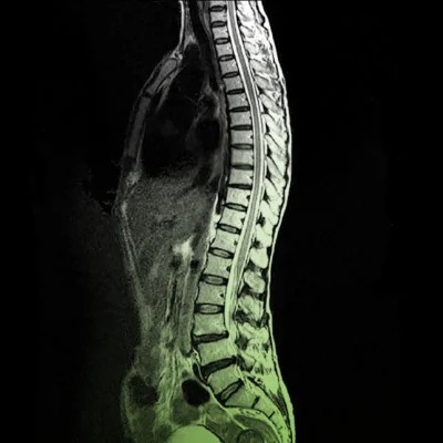 Дегенеративно дистрофічні зміни грудного відділу хребта: симптоми і лікування