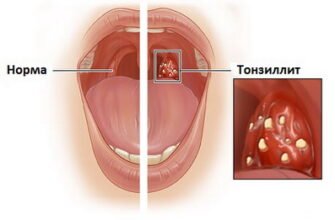 Чи можна вилікувати хронічний тонзиліт: відповіді та поради лікарів