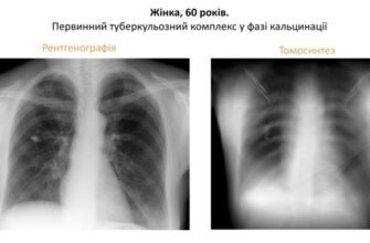 Фіброзні зміни: причини, симптоми та ефективні методи лікування