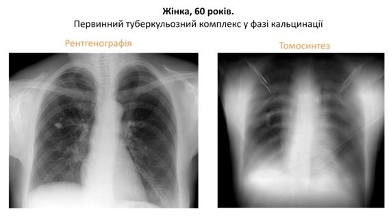 Фіброзні зміни: причини, симптоми та ефективні методи лікування