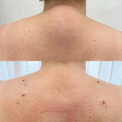 Горб на шиї у дитини: причини, наслідки та методи лікування