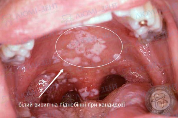 Пухирці в горлі у дитини: причини, симптоми та лікування