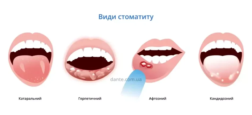 Температура при стоматиті у дітей: причини та поради лікування