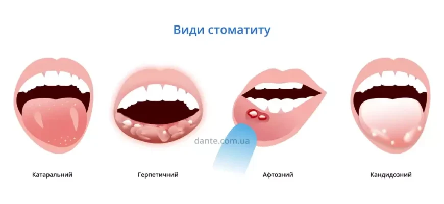 Температура при стоматиті у дітей: причини та поради лікування