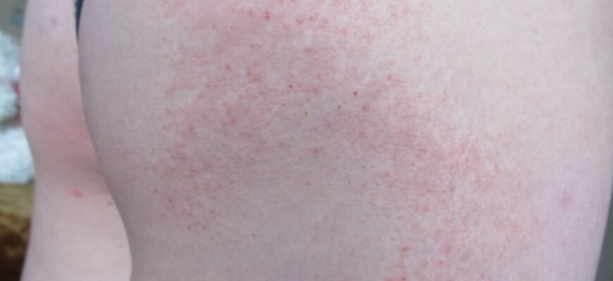 Висип на попі у дитини: причини, діагностика та лікування