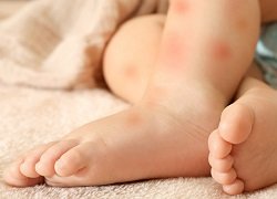 Висипка у дитини: причини, симптоми та методи лікування