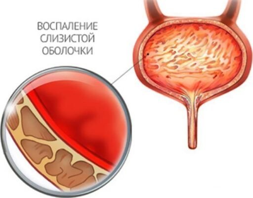Причини та лікування: мутна сеча у дитини – що варто знати батькам