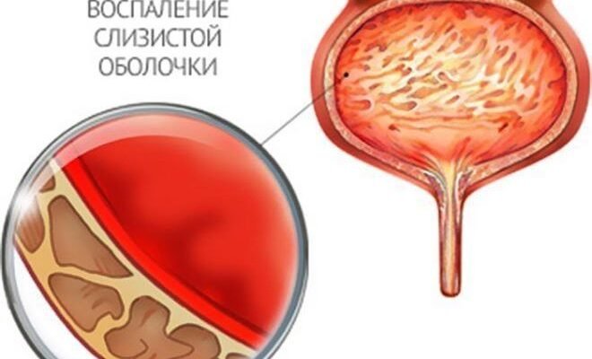 Причини та лікування: мутна сеча у дитини – що варто знати батькам