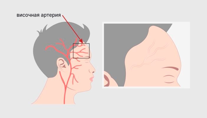 Хвороба Хортона: Симптоми, Діагностика і Методи Лікування Хвороба Хортона: Симптоми, Діагностика і Методи Лікування