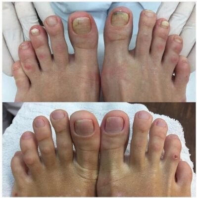 Подолог, що лікує: професійний догляд за вашими стопами