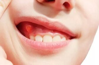 Антибіотики при гранульомі зуба: вибір та ефективність лікування