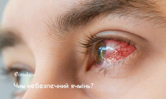 Лікування ячменю на оці у дитини: ефективні методи та поради