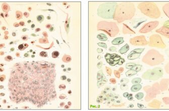 Сквамозні інтраепітеліальні зміни низького ступеня: причини та діагностика