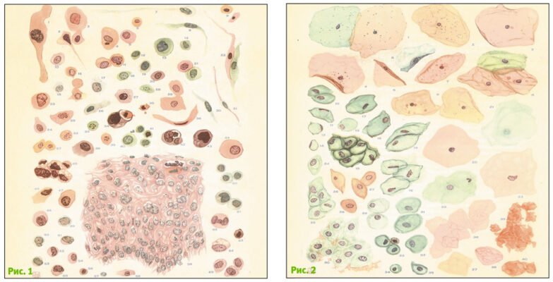 Сквамозні інтраепітеліальні зміни низького ступеня: причини та діагностика