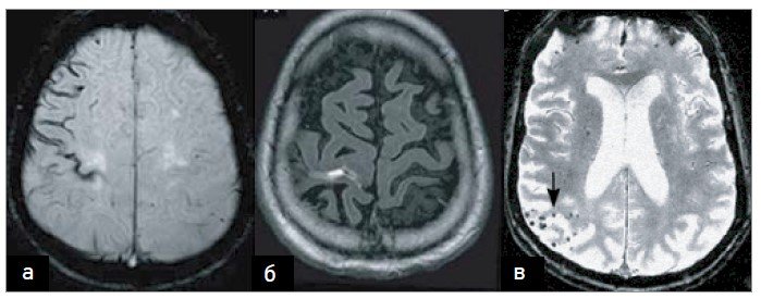 Лікування Хвороби Бінсвангера: Сучасні Підходи та Методики Лікування Хвороби Бінсвангера: Сучасні Підходи та Методики