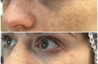 Біоревіталізація обличчя: оптимальна кількість процедур для результату