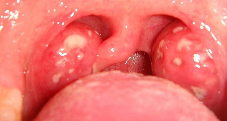 Засоби від болю в горлі при ковтанні: ефективні народні методи ...