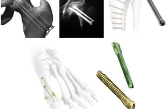 Чи необхідне видалення остеосинтезу після загоєння кісток?