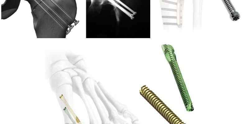 Чи необхідне видалення остеосинтезу після загоєння кісток?