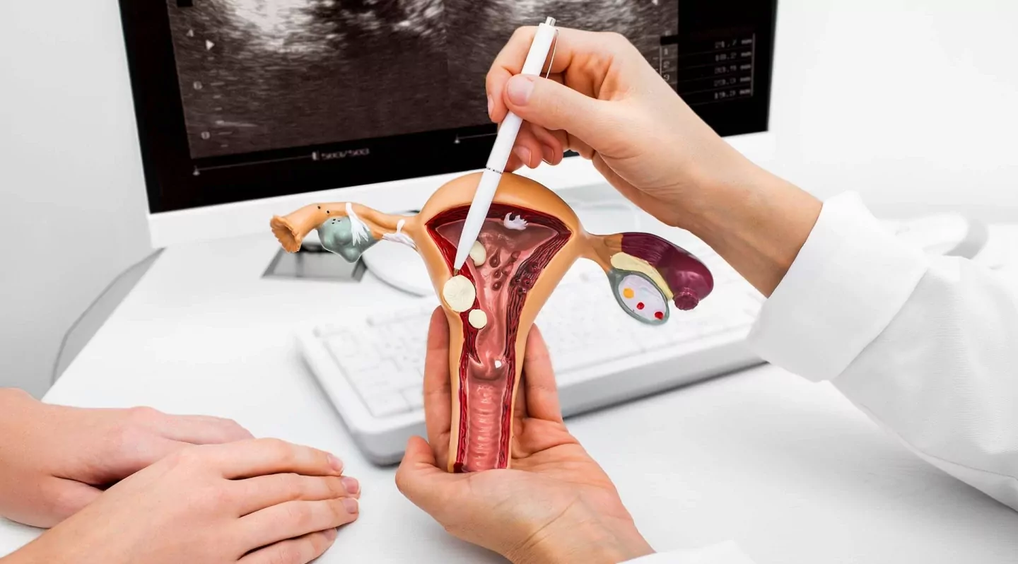 Як проходить видалення поліпів матки — блог медичного центру ОН Клінік