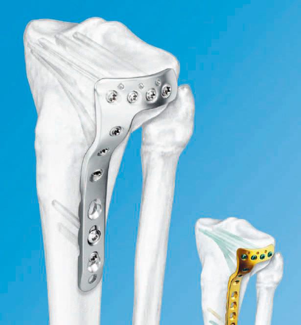 Видаляти чи не видаляти металоконструкції після того, як перелом ...