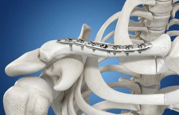 Чи необхідно знімати титанові пластини після операції: експертна думка