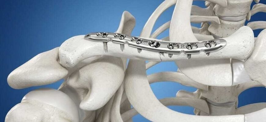 Чи необхідно знімати титанові пластини після операції: експертна думка