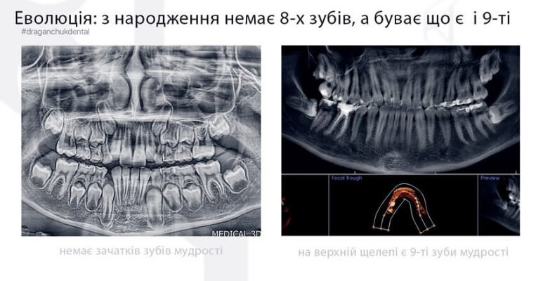 Чи обов’язково виривати зуби мудрості: міфи та реальність