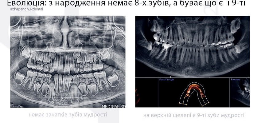 Чи обов’язково виривати зуби мудрості: міфи та реальність