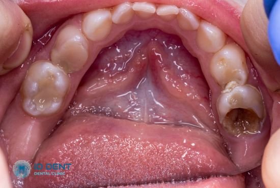 Чи потрібно лікувати молочні зуби: думки та відгуки батьків і стоматологів