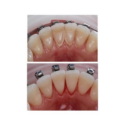 Чи потрібно видаляти зубний камінь: важливість гігієни для здоров’я зубів