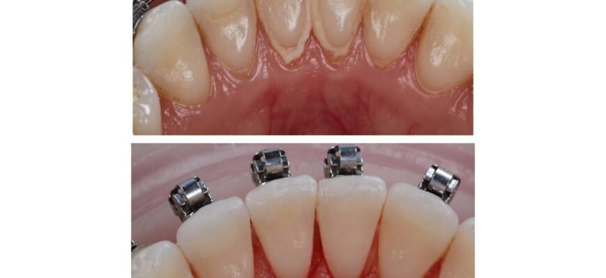 Чи потрібно видаляти зубний камінь: важливість гігієни для здоров’я зубів