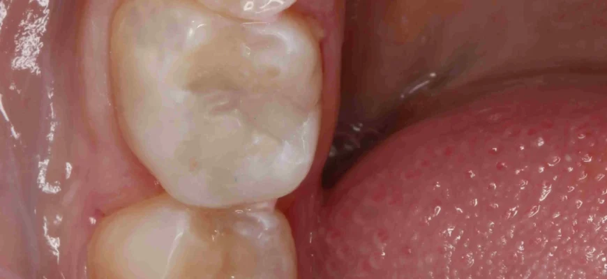 Чи варто лікувати карієс молочних зубів: важливість та рекомендації